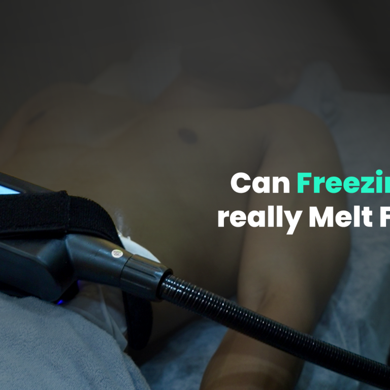 Cryolipolysis Treatment in Chennai