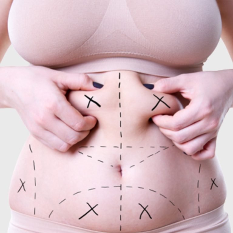 laser-assisted-liposuction